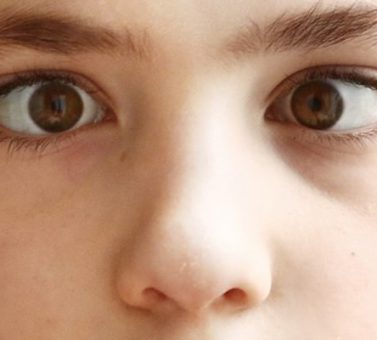 درمان انحراف چشم با قطره‌های آتروپین رقیق‌شده