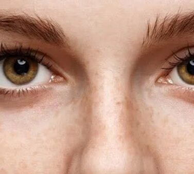 آیا انحراف چشم (استرابیسم) همیشه نیاز به جراحی دارد؟