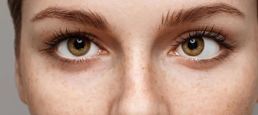 آیا انحراف چشم (استرابیسم) همیشه نیاز به جراحی دارد؟