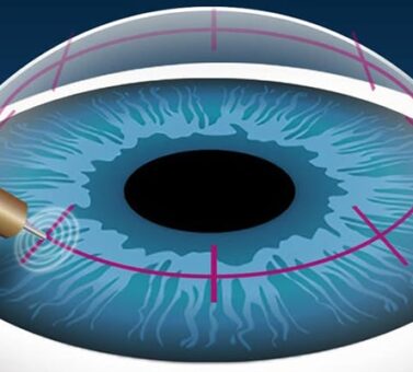 چرا جراحی برای پیرچشمی اصلاً توصیه نمی‌شود؟