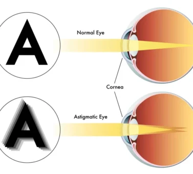 آستیگماتیسم، نزدیک‌بینی و دوربینی؛ عینک طبی چگونه این سه عیب چشم را اصلاح می‌کند؟