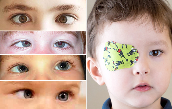 👶 عیوب انکساری در کودکان و نوجوانان