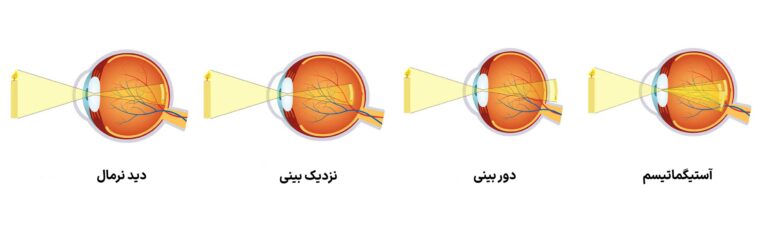 آستیگماتیسم، نزدیکبینی و دوربینی؛ عینک طبی چگونه این سه عیب چشم را اصلاح میکند؟