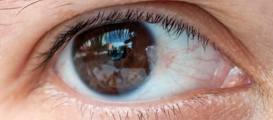 ناخنک چشم (پتریژیوم): علل، علائم، درمان و پیشگیری + نکات مهم برای رانندگان