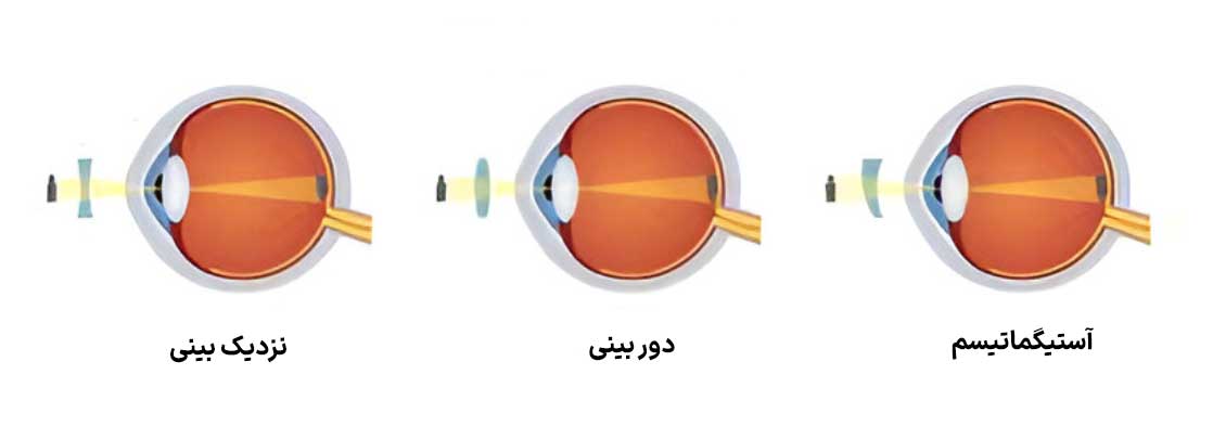 آستیگماتیسم، نزدیکبینی و دوربینی؛ عینک طبی چگونه این سه عیب چشم را اصلاح میکند؟