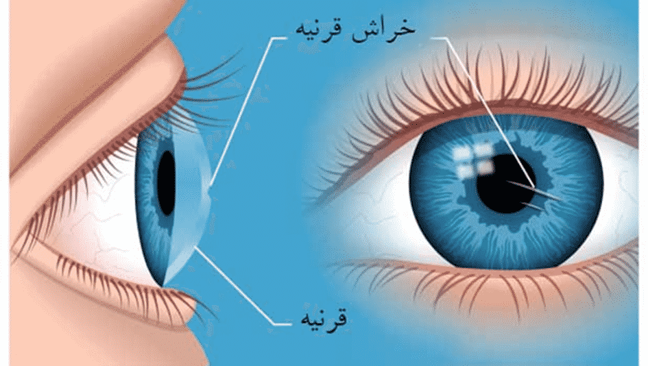 🩹 کمک‌های اولیه برای خراشیدگی قرنیه و ساییدگی سطح چشم