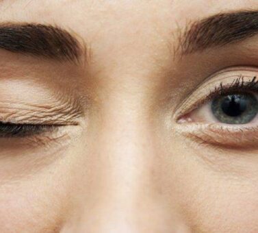 نیستاگموس (لرزش چشم): راهنمای علمی و جامع برای تشخیص و درمان