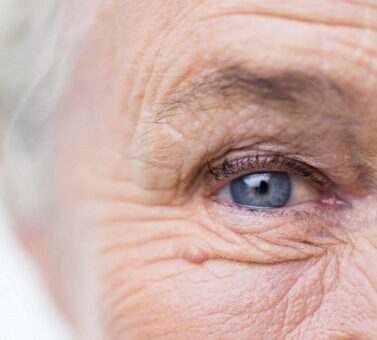 پیرچشمی چیست؟ علت‌ها، علائم و روش‌های درمان مؤثر | راهنمای جامع و علمی