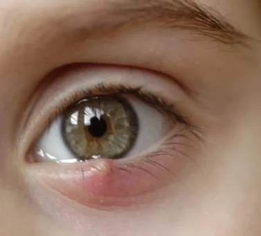 عفونت چشم کودکان: تشخیص، درمان و پیشگیری | راهنمای جامع والدین