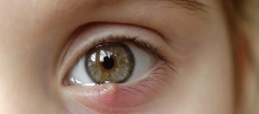 عفونت چشم کودکان: تشخیص، درمان و پیشگیری | راهنمای جامع والدین