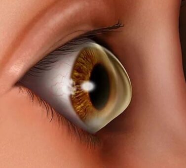 قوز قرنیه (کراتوکونوس): راهنمای کامل از تشخیص تا جدیدترین روش‌های درمان