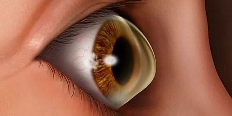 قوز قرنیه (کراتوکونوس): راهنمای کامل از تشخیص تا جدیدترین روش‌های درمان