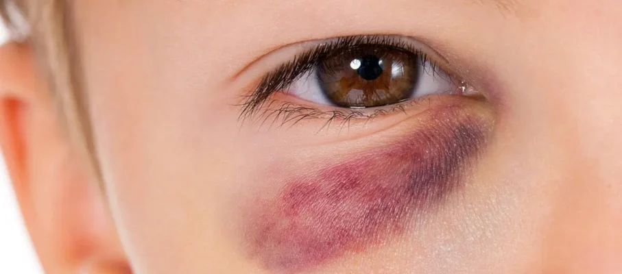 علل، درمان و پیشگیری از کبودی زیر چشم کودکان: راهنمای کامل والدین