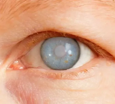 جراحی گلوکوم (آب سیاه): علت، مراحل، نتایج و راهنمای کامل درمان