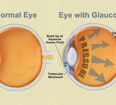فشار چشم چیست؟