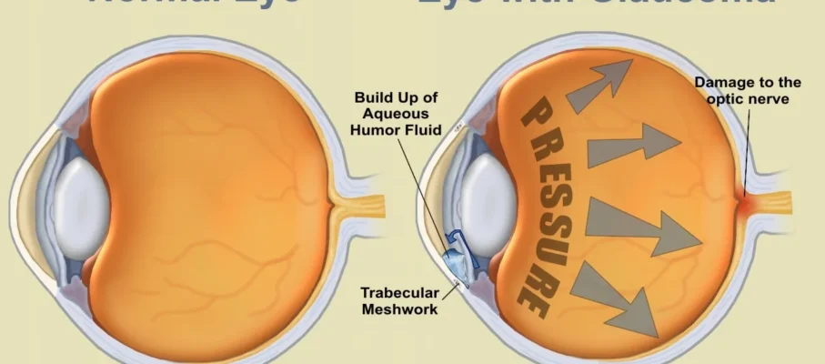 فشار چشم چیست؟