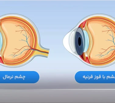 قوز قرنیه (کراتوکونوس) چیست؟ علائم، تشخیص علمی و روش‌های درمان پیشرفته