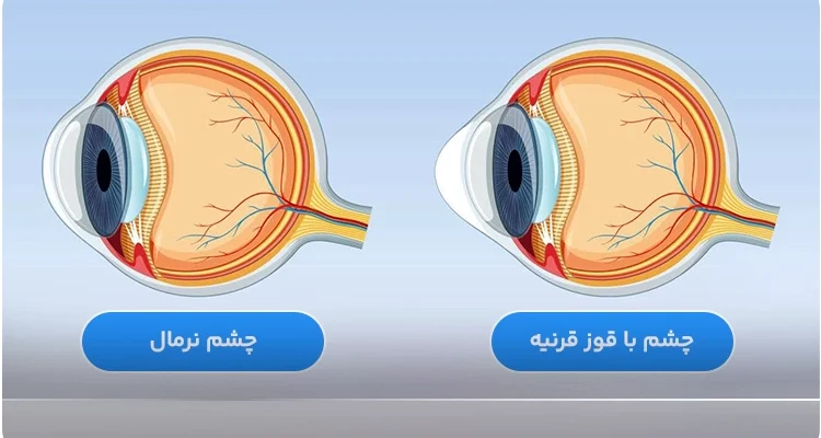 قوز قرنیه (کراتوکونوس) چیست؟ علائم، تشخیص علمی و روش‌های درمان پیشرفته
