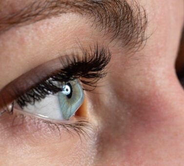 درمان خانگی قوز قرنیه چشم: ۸ روش طبیعی برای مدیریت علائم + راهنمای جامع