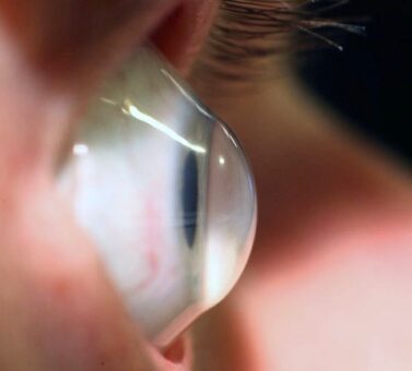 👁️قوز قرنیه (کراتوکونوس): از علائم و تشخیص تا جدیدترین روش‌های درمان