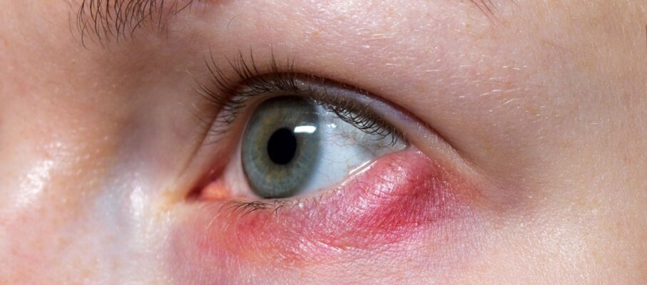 داکریوسیستیت چیست؟ علل، علائم، تشخیص و بهترین روش‌های درمان التهاب کیسه اشکی