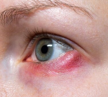 بلفاریت چیست؟ — التهاب پلک، علل، درمان و پیشگیری