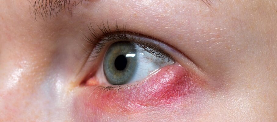 بلفاریت چیست؟ — التهاب پلک، علل، درمان و پیشگیری