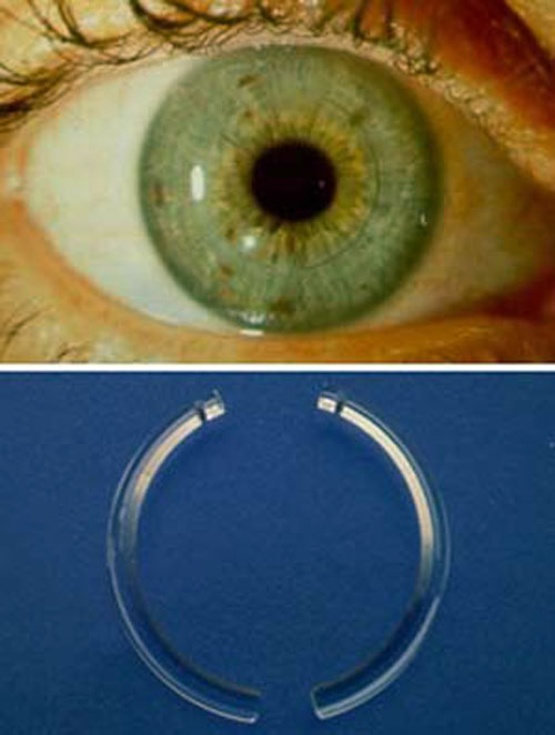 👁️قوز قرنیه (کراتوکونوس): از علائم و تشخیص تا جدیدترین روش‌های درمان