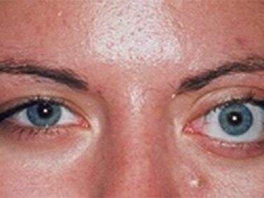 تومور مداری (پشت چشم)؛ علائم، تشخیص و راهکارهای درمان — راهنمای کامل