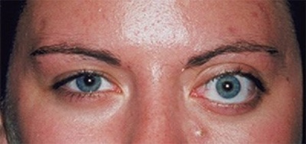 تومور مداری (پشت چشم)؛ علائم، تشخیص و راهکارهای درمان — راهنمای کامل