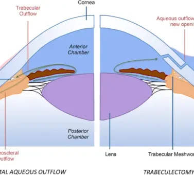 عمل جراحی ترابکولکتومی؛ راهنمای جامع و علمی درمان گلوکوم (آب سیاه چشم)