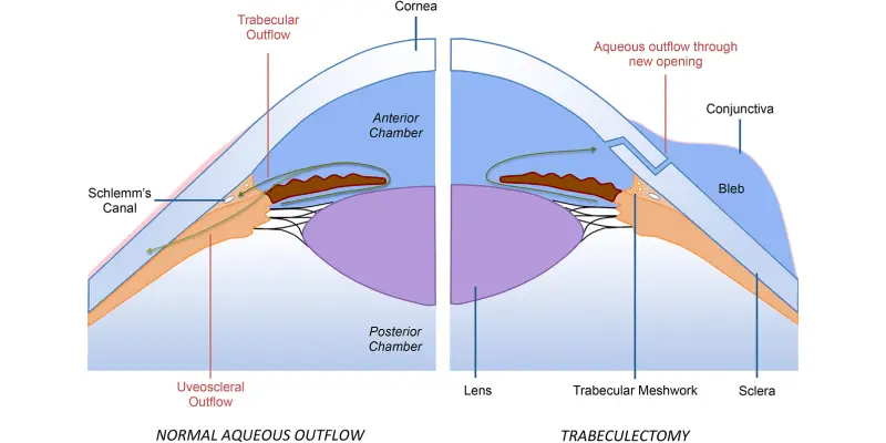 عمل جراحی ترابکولکتومی؛ راهنمای جامع و علمی درمان گلوکوم (آب سیاه چشم)
