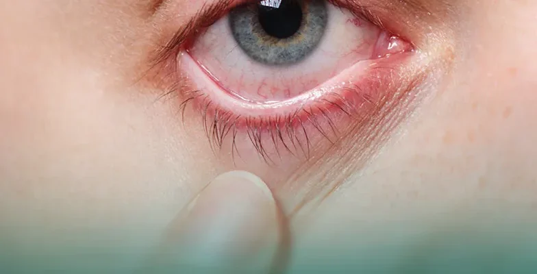 آیا با وجود خشکی چشم می‌توان عمل لیزیک انجام داد؟