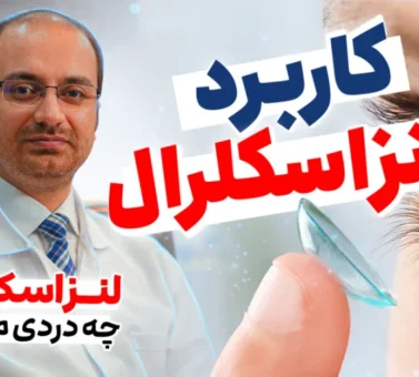 لنز اسکلرال چیست؟ کاربرد، مزایا و درمان قوز قرنیه با لنز اسکلرال