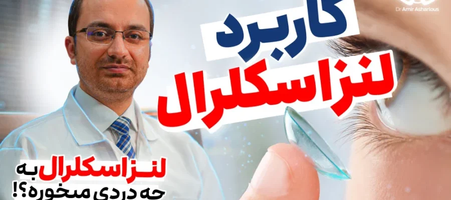 لنز اسکلرال چیست؟ کاربرد، مزایا و درمان قوز قرنیه با لنز اسکلرال