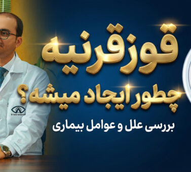 قوزقرنیه چطور ایجاد میشه ؟