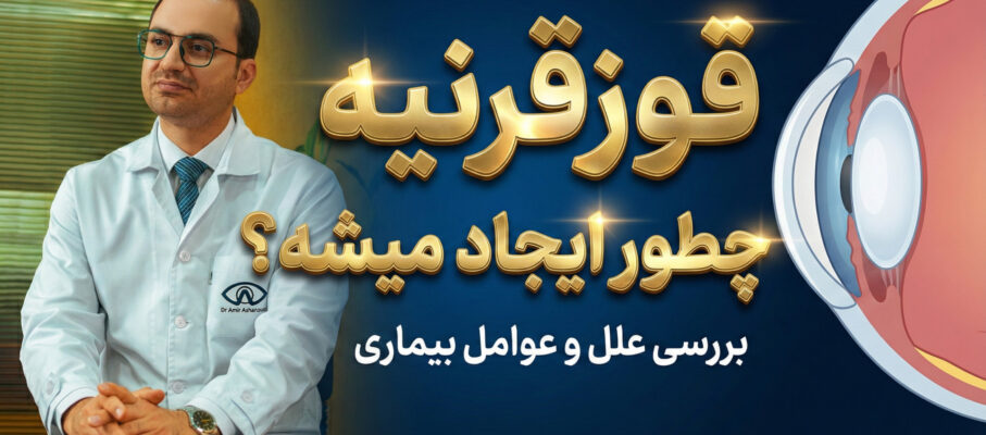 قوزقرنیه چطور ایجاد میشه ؟