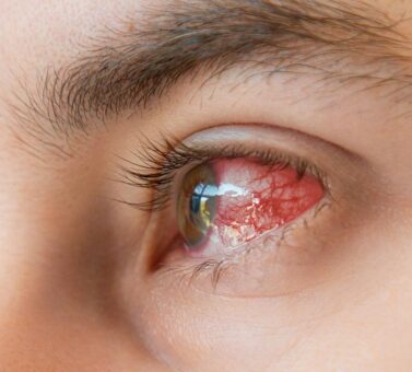 عفونت چشم چیست؟ علائم، علت‌ها، تشخیص و درمان علمی