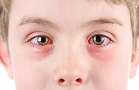 علت التهاب چشم کودکان، علائم، تشخیص و درمان