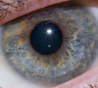 رد پیوند قرنیه چیست؟ علائم، دلایل، درمان و پیشگیری از رد پیوند قرنیه بعد از جراحی