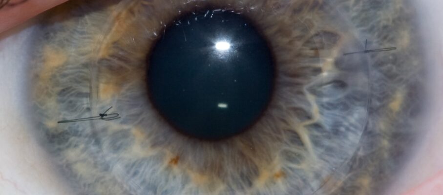 رد پیوند قرنیه چیست؟ علائم، دلایل، درمان و پیشگیری از رد پیوند قرنیه بعد از جراحی