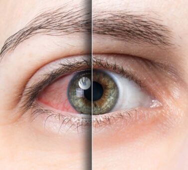 تفاوت خشکی چشم و آلرژی چشمی؛ چگونه علائم این دو عارضه را از هم تشخیص دهیم؟