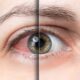 تفاوت خشکی چشم و آلرژی چشمی؛ چگونه علائم این دو عارضه را از هم تشخیص دهیم؟