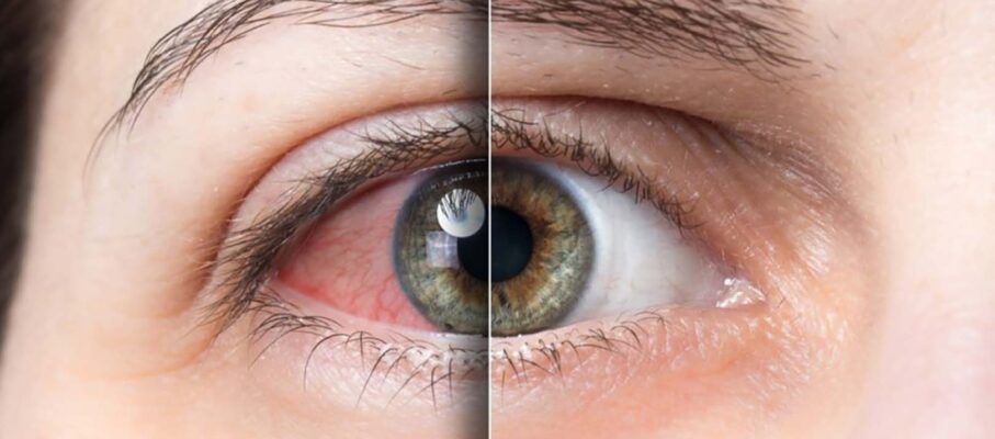 تفاوت خشکی چشم و آلرژی چشمی؛ چگونه علائم این دو عارضه را از هم تشخیص دهیم؟