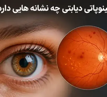 رتینوپاتی دیابتی چه نشانه هایی دارد؟ راهنمای شناخت علائم و زمان مراجعه به متخصص