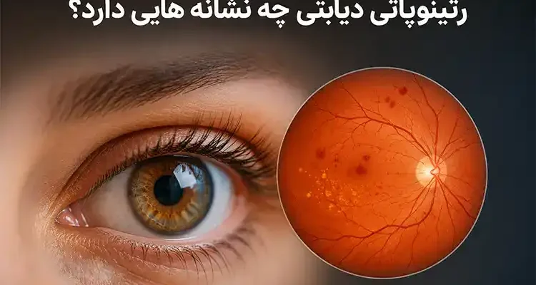 رتینوپاتی دیابتی چه نشانه هایی دارد؟ راهنمای شناخت علائم و زمان مراجعه به متخصص
