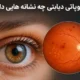 رتینوپاتی دیابتی چه نشانه هایی دارد؟ راهنمای شناخت علائم و زمان مراجعه به متخصص