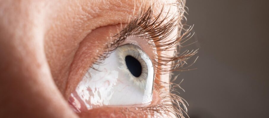 قوز قرنیه چیست؟ علائم، علل و روش های درمانی نوین