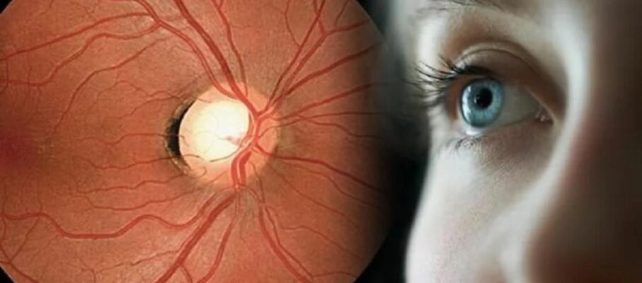 دژنراسیون ماکولا چیست؟ علائم، دلایل و روش‌ های درمان